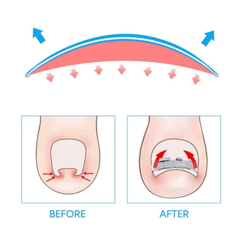 Νάρθηκας Ονυχοκρύπτωσης Μεταλλικός Με Προέκταση